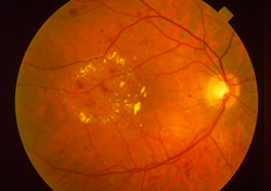 Diabetic Retinopathy - hard exudates