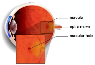p-macular-hole