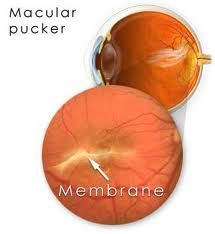 p-macular-pucker