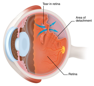 p-retinal-detatchment-k75